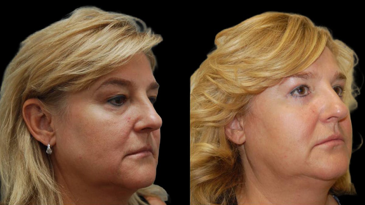 Upper & Lower Eyelid Surgery Before & After Gallery - Patient 246596 - Image 7