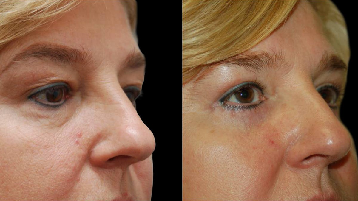 Upper & Lower Eyelid Surgery Before & After Gallery - Patient 246596 - Image 8