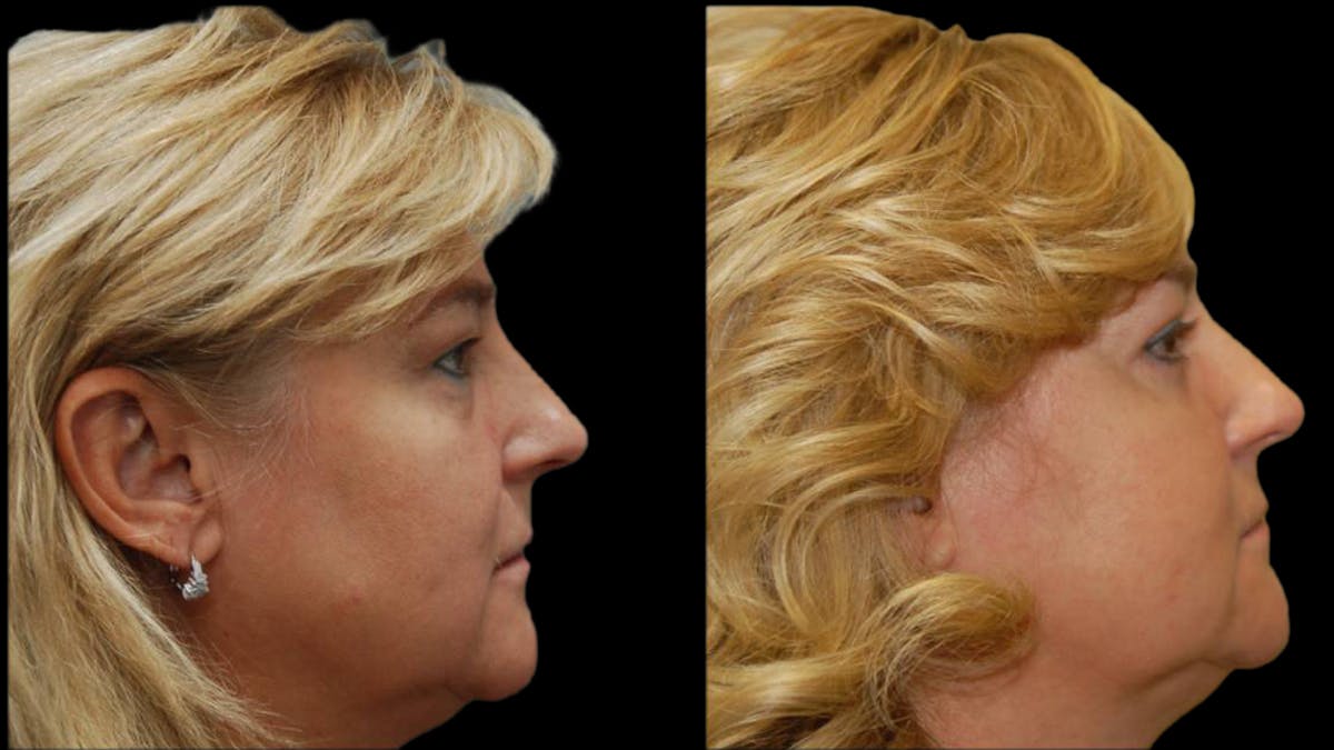 Upper & Lower Eyelid Surgery Before & After Gallery - Patient 246596 - Image 9