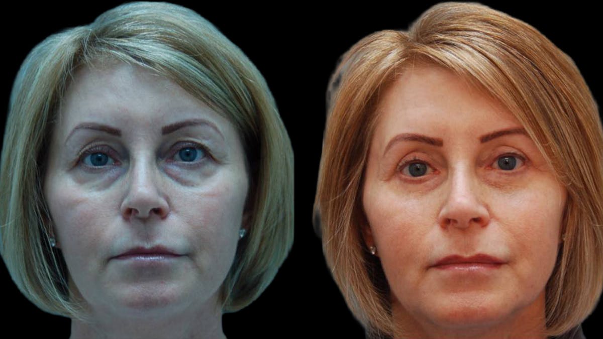 Upper & Lower Eyelid Surgery Before & After Gallery - Patient 365767 - Image 1