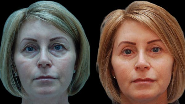 Upper & Lower Eyelid Surgery Before & After Gallery - Patient 365767 - Image 1
