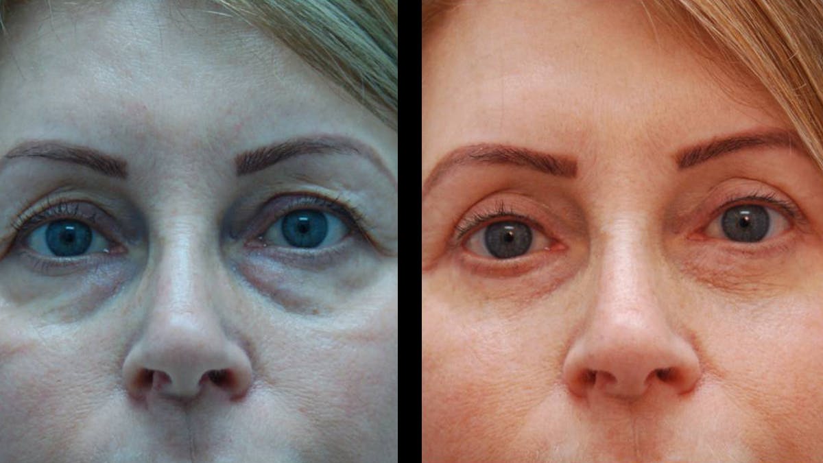 Upper & Lower Eyelid Surgery Before & After Gallery - Patient 365767 - Image 2