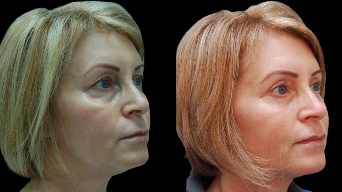Upper & Lower Eyelid Surgery Before & After Gallery - Patient 365767 - Image 3