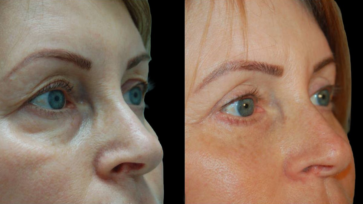 Upper & Lower Eyelid Surgery Before & After Gallery - Patient 365767 - Image 4