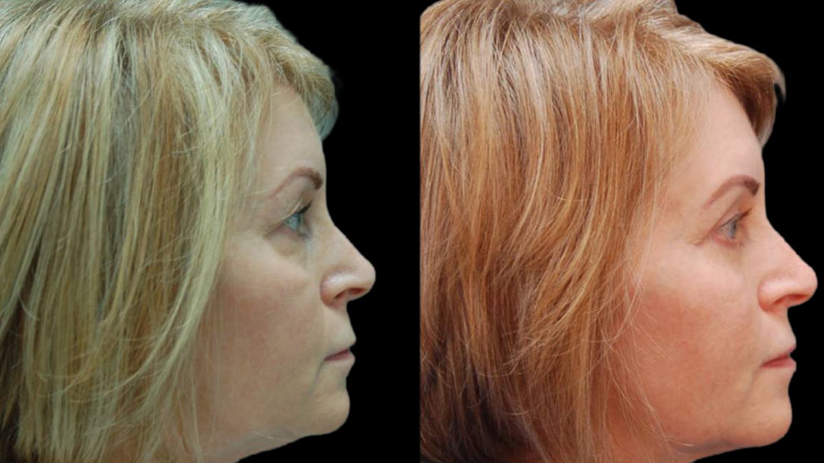 Upper & Lower Eyelid Surgery Before & After Gallery - Patient 365767 - Image 5
