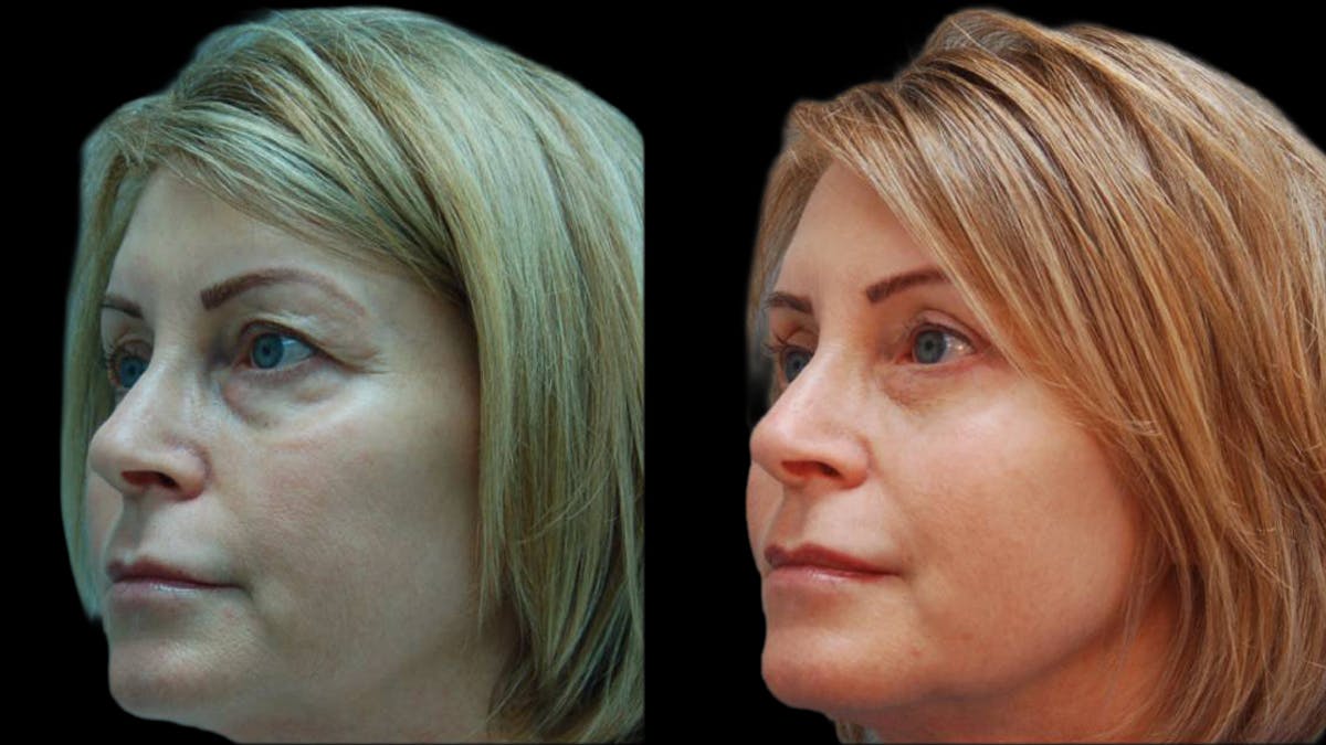Upper & Lower Eyelid Surgery Before & After Gallery - Patient 365767 - Image 6