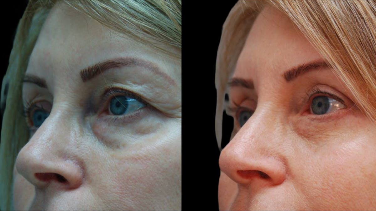 Upper & Lower Eyelid Surgery Before & After Gallery - Patient 365767 - Image 7
