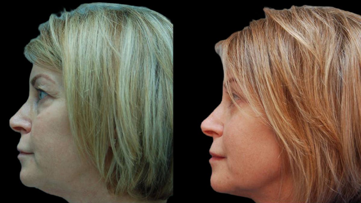 Upper & Lower Eyelid Surgery Before & After Gallery - Patient 365767 - Image 8