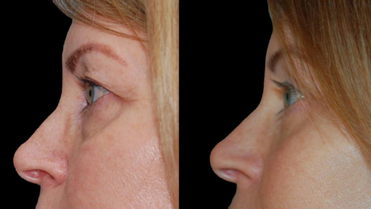 Upper & Lower Eyelid Surgery Before & After Gallery - Patient 365767 - Image 9