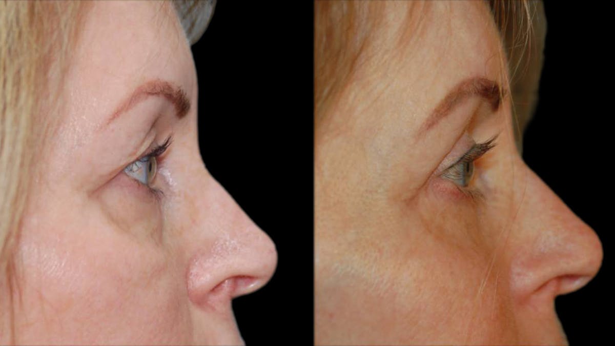 Upper & Lower Eyelid Surgery Before & After Gallery - Patient 365767 - Image 10