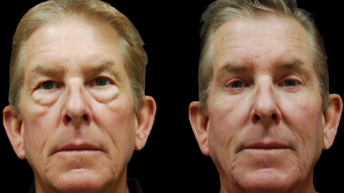 Upper & Lower Eyelid Surgery Before & After Gallery - Patient 196652 - Image 1