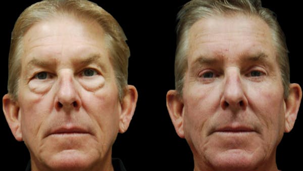Upper & Lower Eyelid Surgery Before & After Gallery - Patient 196652 - Image 1