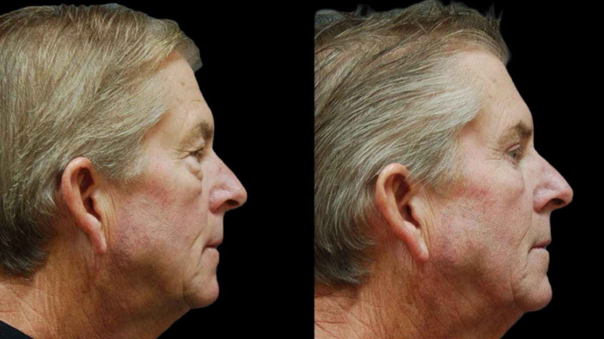 Upper & Lower Eyelid Surgery Before & After Gallery - Patient 196652 - Image 3