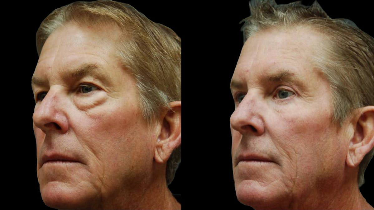 Upper & Lower Eyelid Surgery Before & After Gallery - Patient 196652 - Image 4