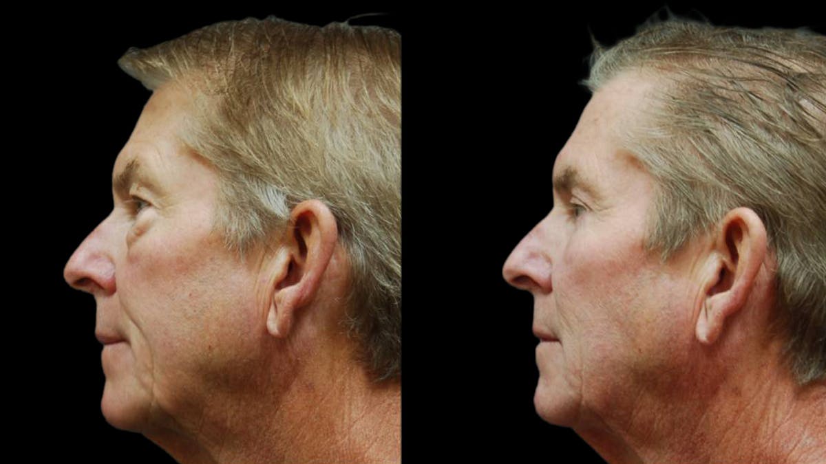 Upper & Lower Eyelid Surgery Before & After Gallery - Patient 196652 - Image 5