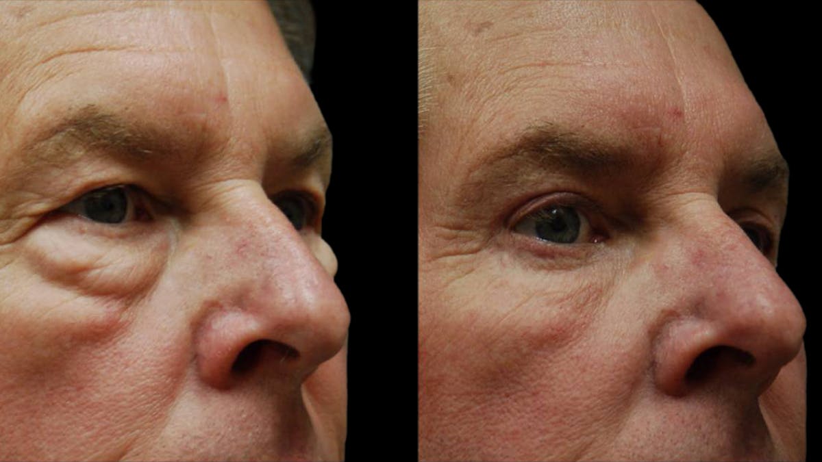 Upper & Lower Eyelid Surgery Before & After Gallery - Patient 196652 - Image 6