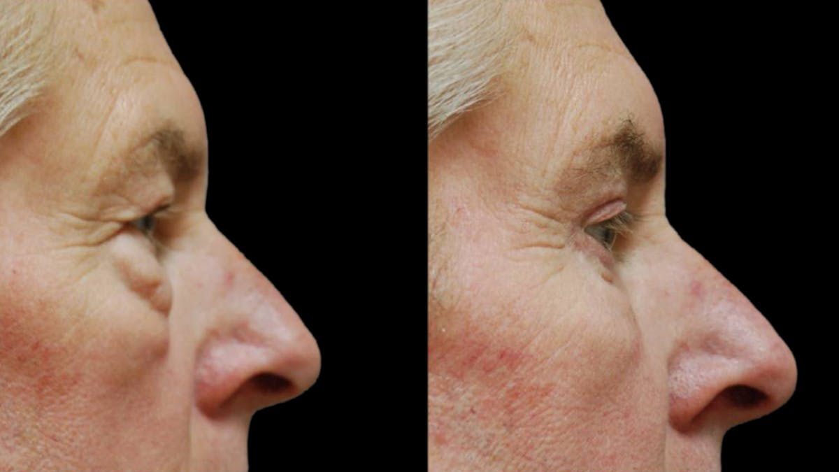 Upper & Lower Eyelid Surgery Before & After Gallery - Patient 196652 - Image 7
