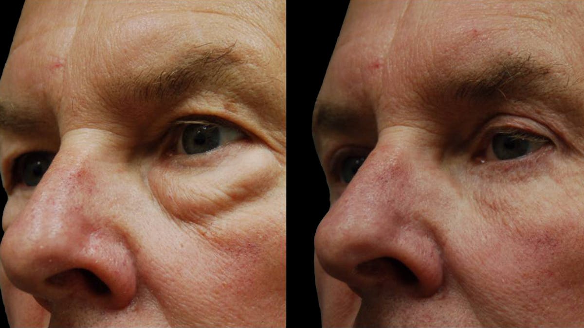 Upper & Lower Eyelid Surgery Before & After Gallery - Patient 196652 - Image 8