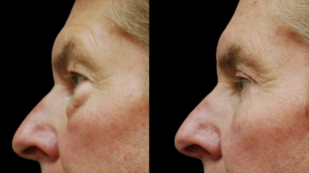 Upper & Lower Eyelid Surgery Before & After Gallery - Patient 196652 - Image 9