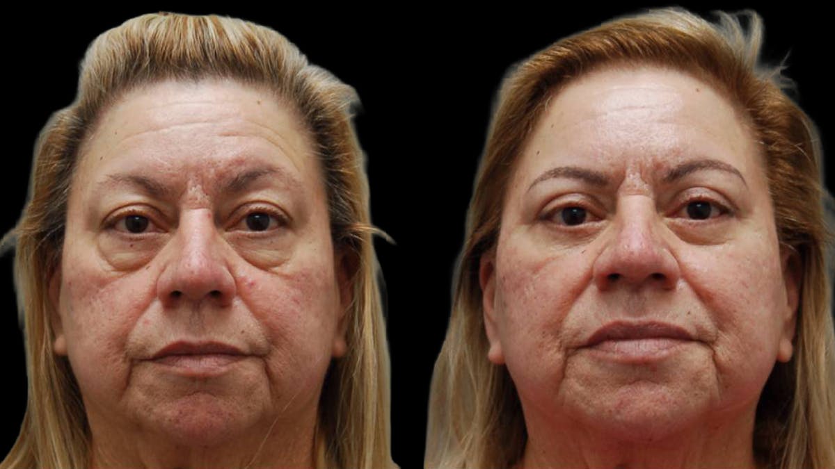 Upper & Lower Eyelid Surgery Before & After Gallery - Patient 333396 - Image 1