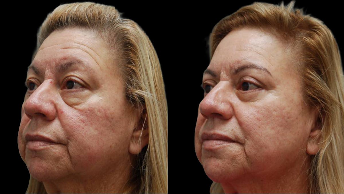 Upper & Lower Eyelid Surgery Before & After Gallery - Patient 333396 - Image 2