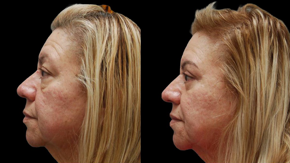 Upper & Lower Eyelid Surgery Before & After Gallery - Patient 333396 - Image 3