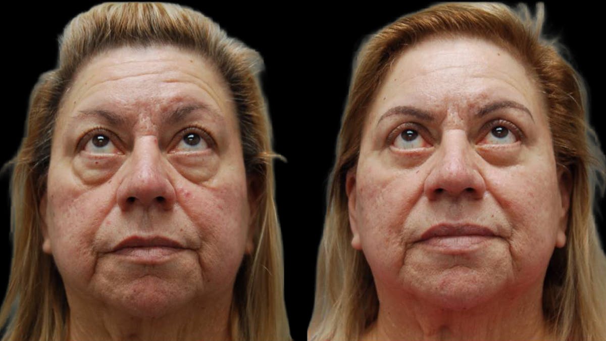 Upper & Lower Eyelid Surgery Before & After Gallery - Patient 333396 - Image 4