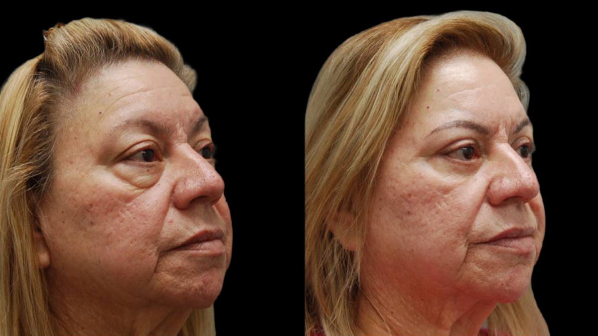 Upper & Lower Eyelid Surgery Before & After Gallery - Patient 333396 - Image 5
