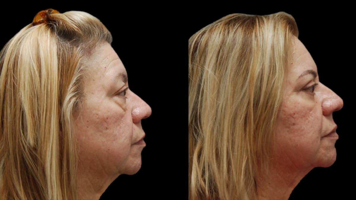 Upper & Lower Eyelid Surgery Before & After Gallery - Patient 333396 - Image 6