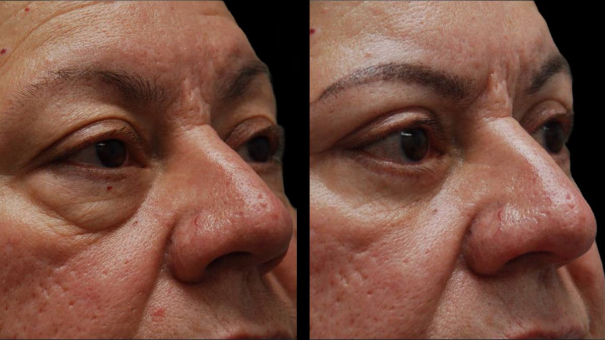Upper & Lower Eyelid Surgery Before & After Gallery - Patient 333396 - Image 7