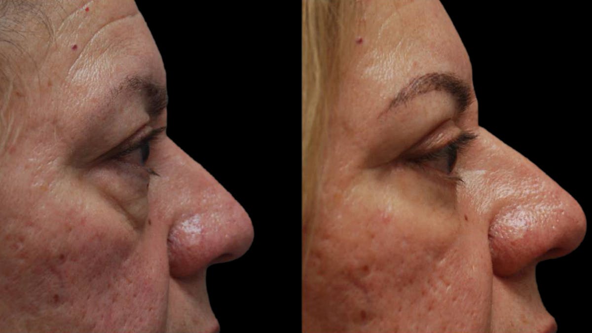 Upper & Lower Eyelid Surgery Before & After Gallery - Patient 333396 - Image 8