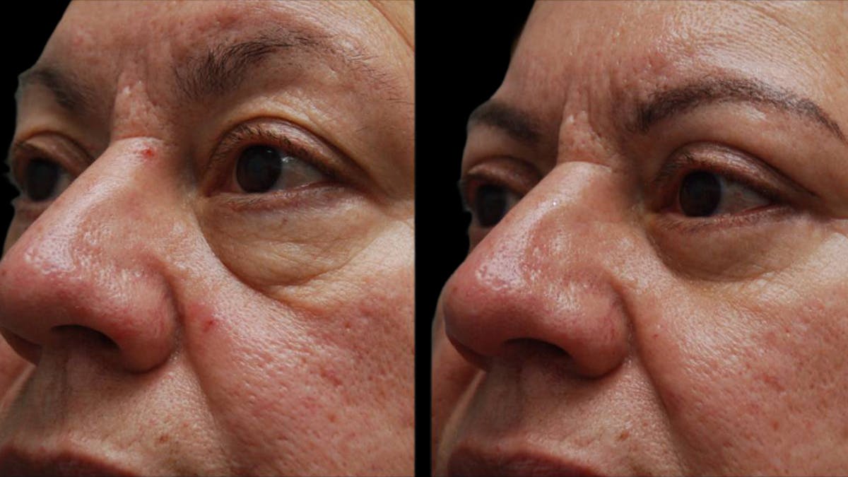 Upper & Lower Eyelid Surgery Before & After Gallery - Patient 333396 - Image 9
