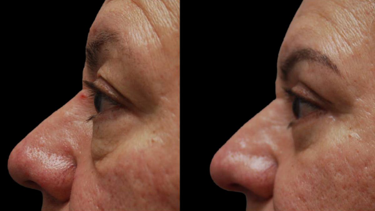 Upper & Lower Eyelid Surgery Before & After Gallery - Patient 333396 - Image 10