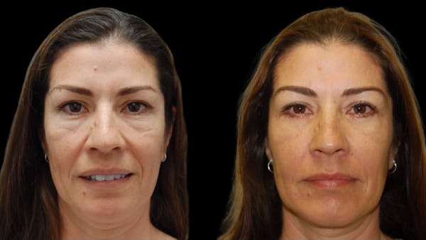 Upper & Lower Eyelid Surgery Before & After Gallery - Patient 324735 - Image 1