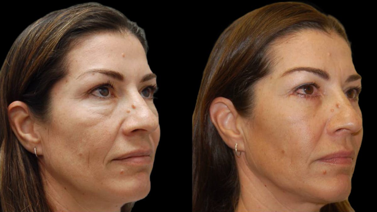 Upper & Lower Eyelid Surgery Before & After Gallery - Patient 324735 - Image 2