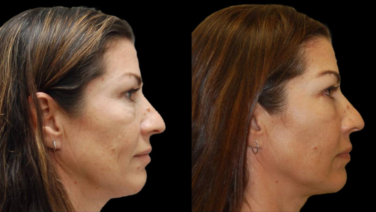 Upper & Lower Eyelid Surgery Before & After Gallery - Patient 324735 - Image 3