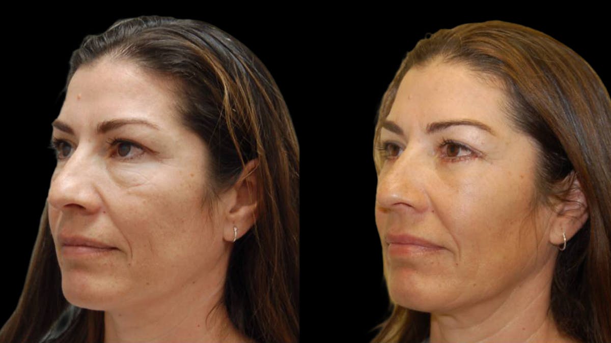 Upper & Lower Eyelid Surgery Before & After Gallery - Patient 324735 - Image 4