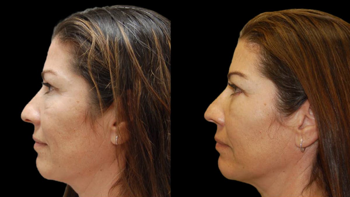 Upper & Lower Eyelid Surgery Before & After Gallery - Patient 324735 - Image 5