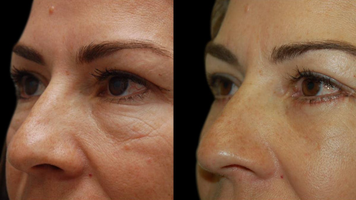 Upper & Lower Eyelid Surgery Before & After Gallery - Patient 324735 - Image 6