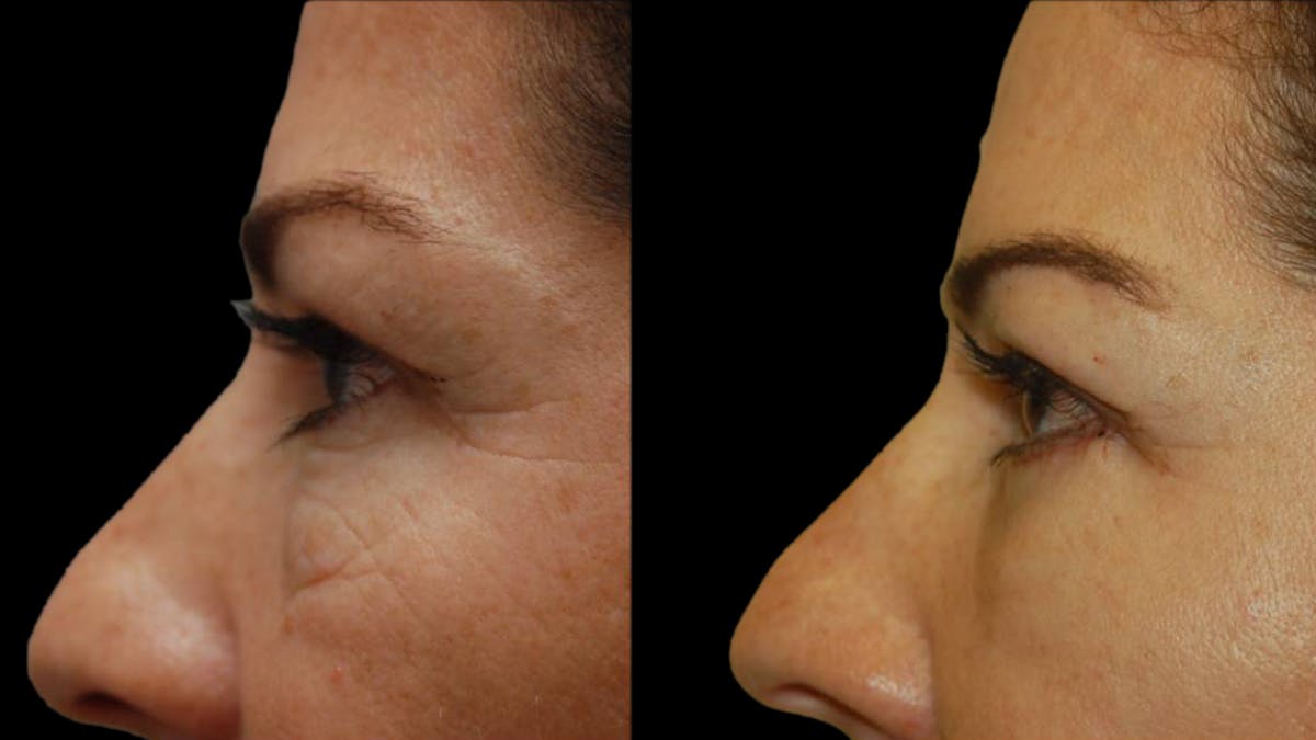 Upper & Lower Eyelid Surgery Before & After Gallery - Patient 324735 - Image 7