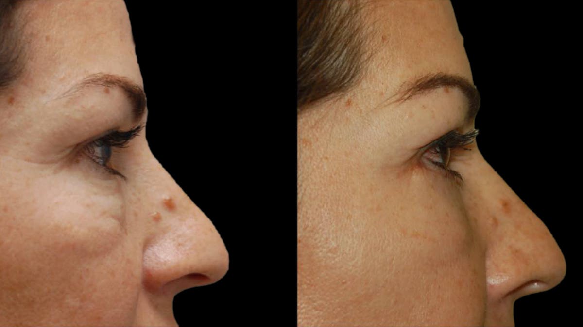 Upper & Lower Eyelid Surgery Before & After Gallery - Patient 324735 - Image 9