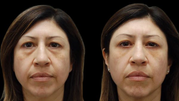 Upper & Lower Eyelid Surgery Before & After Gallery - Patient 572074 - Image 1