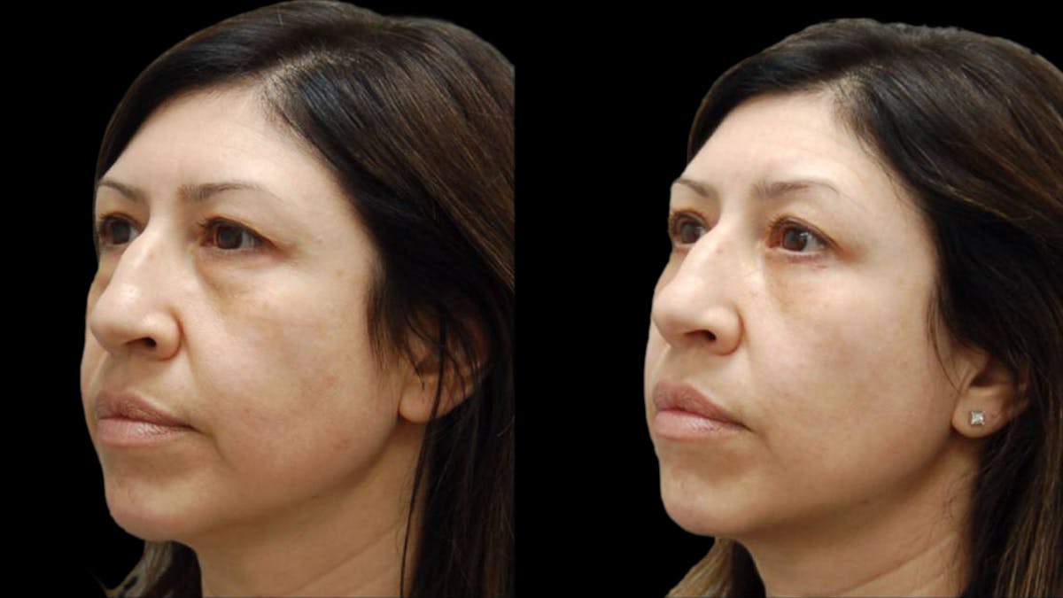 Upper & Lower Eyelid Surgery Before & After Gallery - Patient 572074 - Image 3