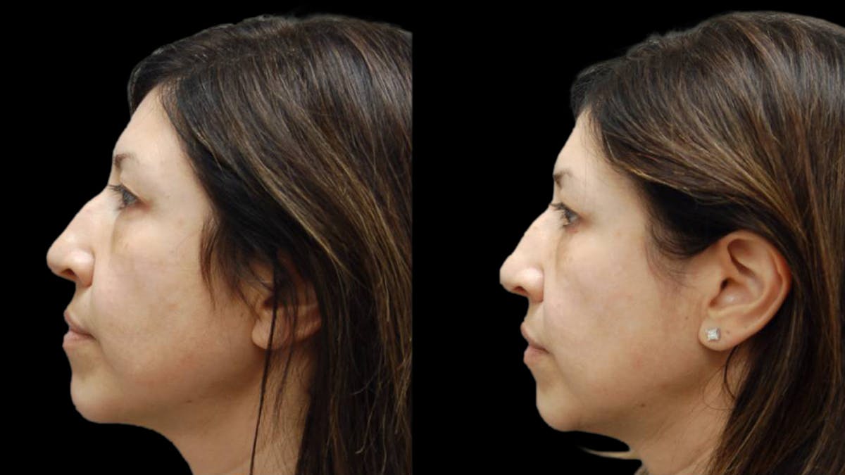 Upper & Lower Eyelid Surgery Before & After Gallery - Patient 572074 - Image 5