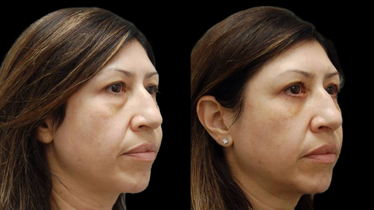 Upper & Lower Eyelid Surgery Before & After Gallery - Patient 572074 - Image 6