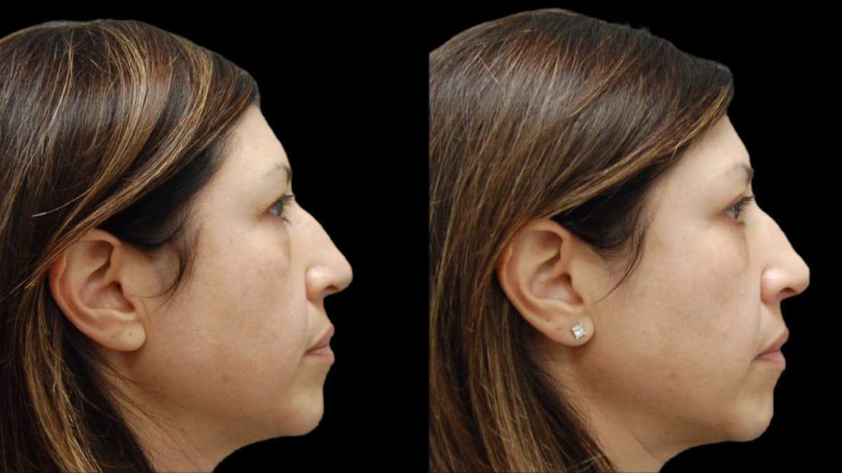 Upper & Lower Eyelid Surgery Before & After Gallery - Patient 572074 - Image 7