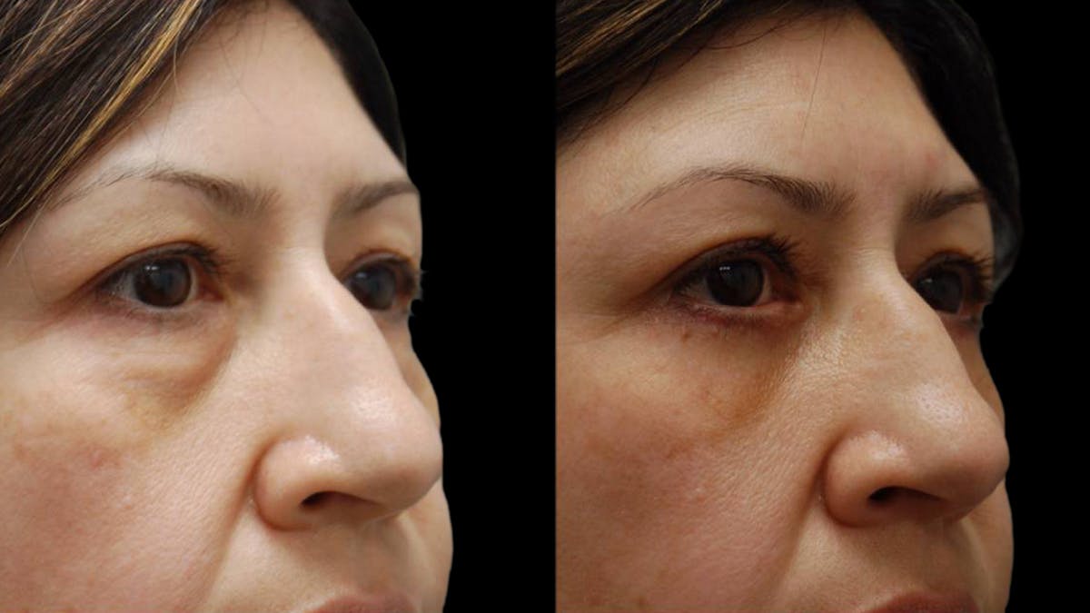 Upper & Lower Eyelid Surgery Before & After Gallery - Patient 572074 - Image 8