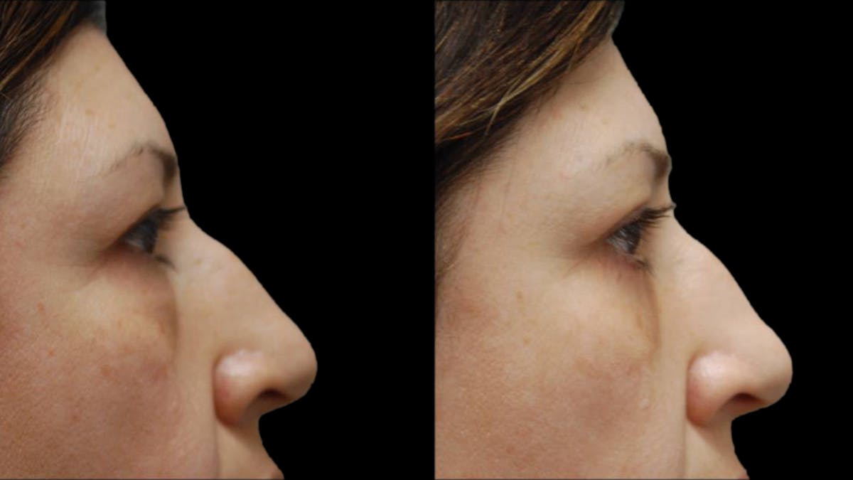 Upper & Lower Eyelid Surgery Before & After Gallery - Patient 572074 - Image 9