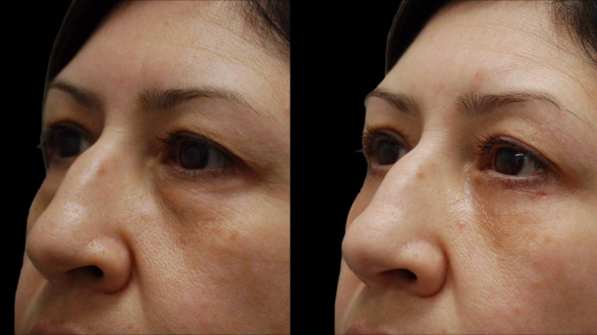 Upper & Lower Eyelid Surgery Before & After Gallery - Patient 572074 - Image 10