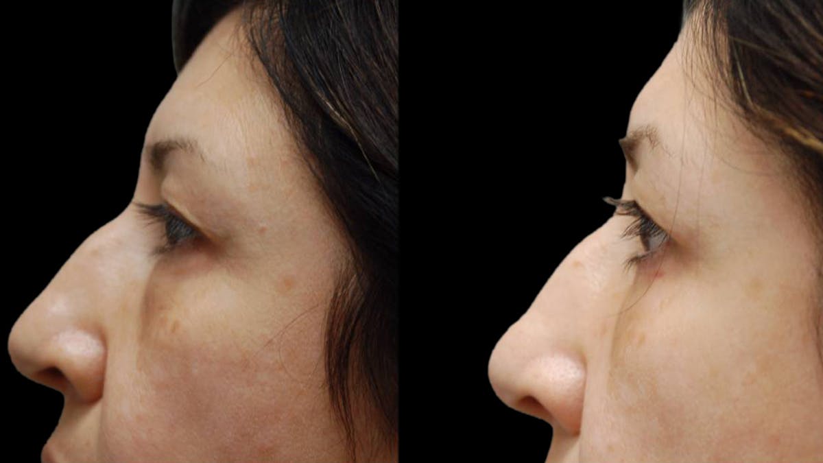 Upper & Lower Eyelid Surgery Before & After Gallery - Patient 572074 - Image 11